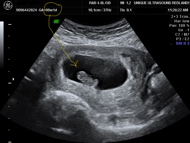 8 week ultraound photo